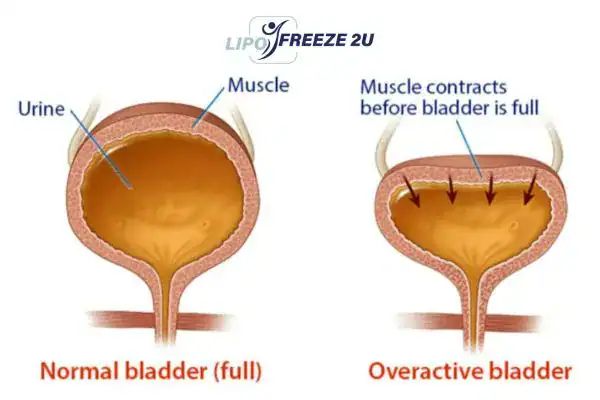 diagram of overactive bladder treatment Busby