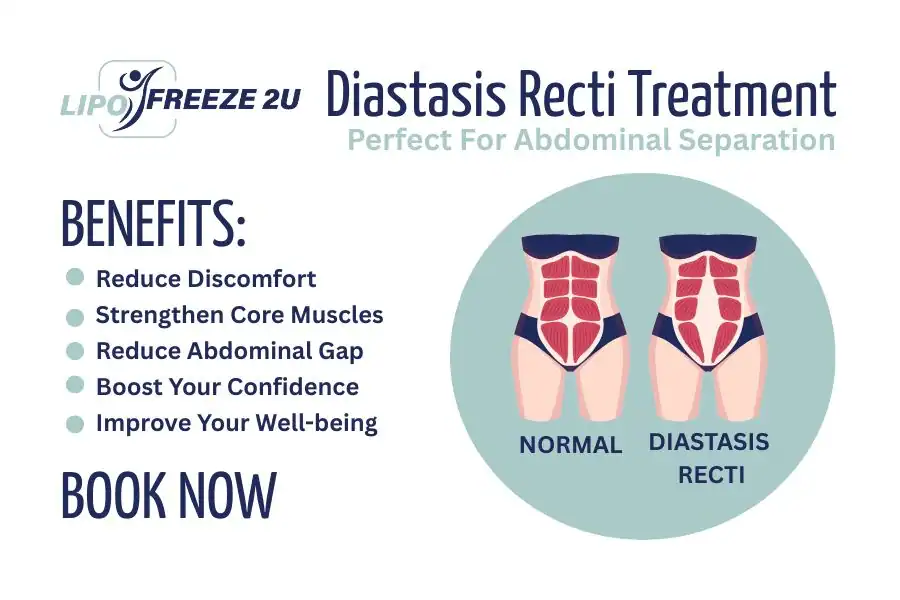 Benefits of body toning treatment Busby for Diastasis recti