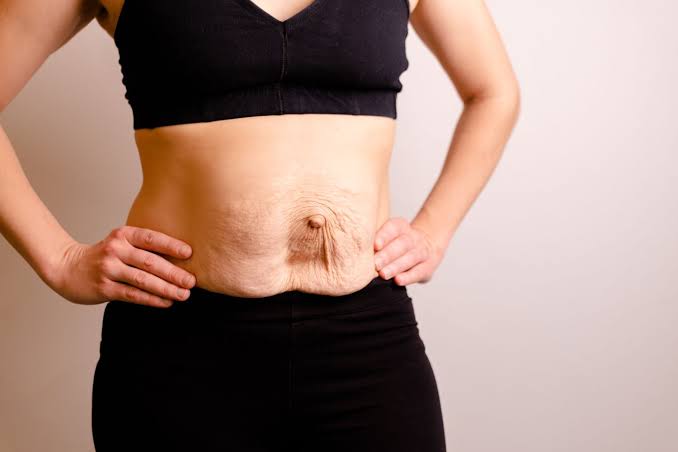 Is Surgery Really the Only Way to Repair Diastasis Recti Busby?