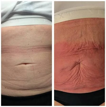 How Does RF Microneedling Improve Crepey, Thin and Uneven Skin Texture Busby?