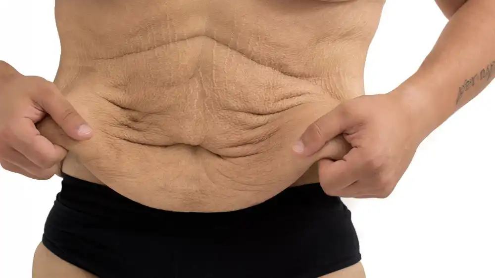 RF Microneedling for Loose Skin: How Can It Help Tighten and Reshape the Skin Busby?